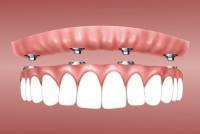 Vollprothese - besserer Halt durch Implantate durch Ihren Zahnarzt Hans Schmücker