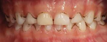 Black Stain-schwarze Zähne bei Kindern: Ihr Zahnarzt Schmücker berät Sie in Ottobeuren Black Stain-schwarze Zähne bei Kindern: Ihr Zahnarzt Schmücker berät Sie in Ottobeuren